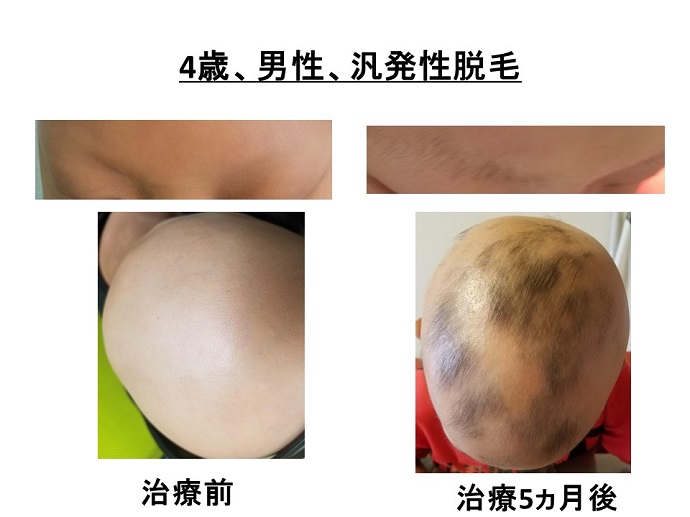 円形脱毛症　病院